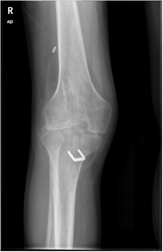 Infected ACL AP